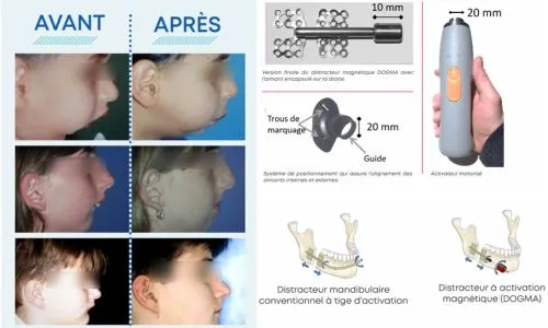 Photos du distracteur Dogma et des « avant-après » de mâchoires d’enfants.